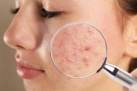 Acne Treatments Service