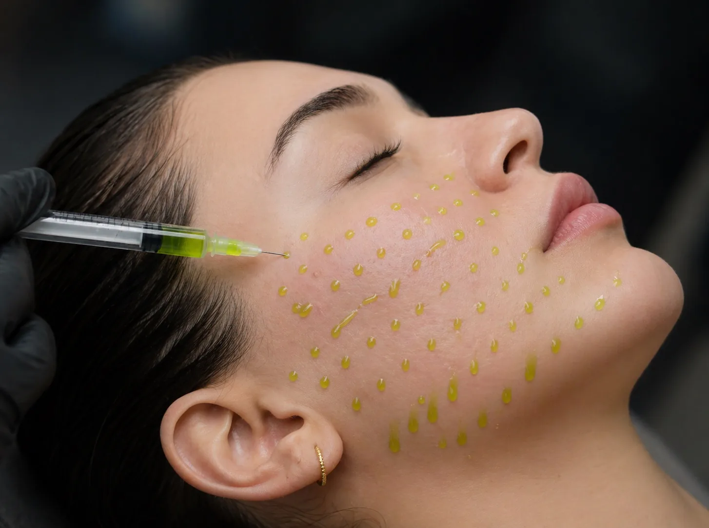 BioRePeel treatment at MASHMEOVER Esthetics in Orange, CA